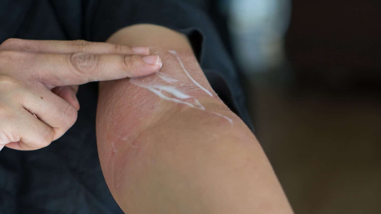 soothing eczema